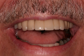 tooth-replacement-1c-275x183